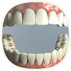 Implantat bei einem fehlenden Zahn