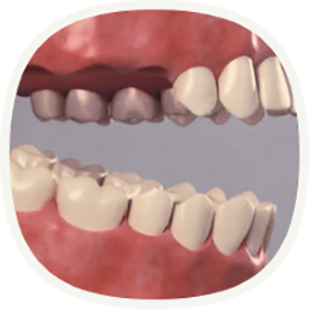 Bei mehreren fehlenden Zähnen