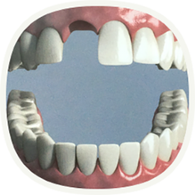 Implantat bei einem fehlenden Zahn