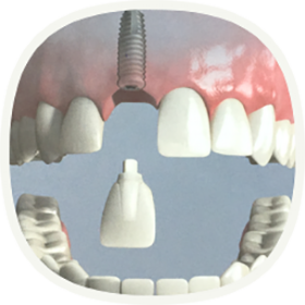 Implantat bei einem fehlenden Zahn