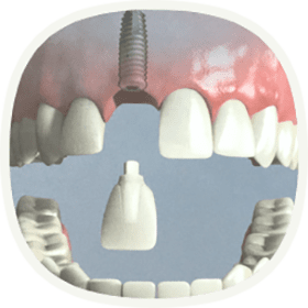 Implantat bei einem fehlenden Zahn
