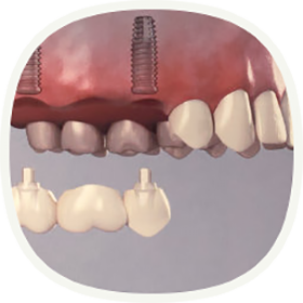 Bei mehreren fehlenden Zähnen