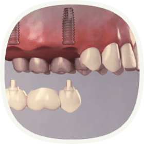 Bei mehreren fehlenden Zähnen