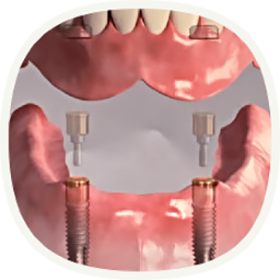 Implantat, wenn alle Zähne ersetzt werden