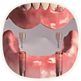Implantat, wenn alle Zähne ersetzt werden