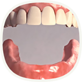 Implantat, wenn alle Zähne ersetzt werden