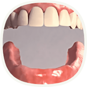 Implantat, wenn alle Zähne ersetzt werden