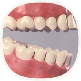 Bei mehreren fehlenden Zähnen